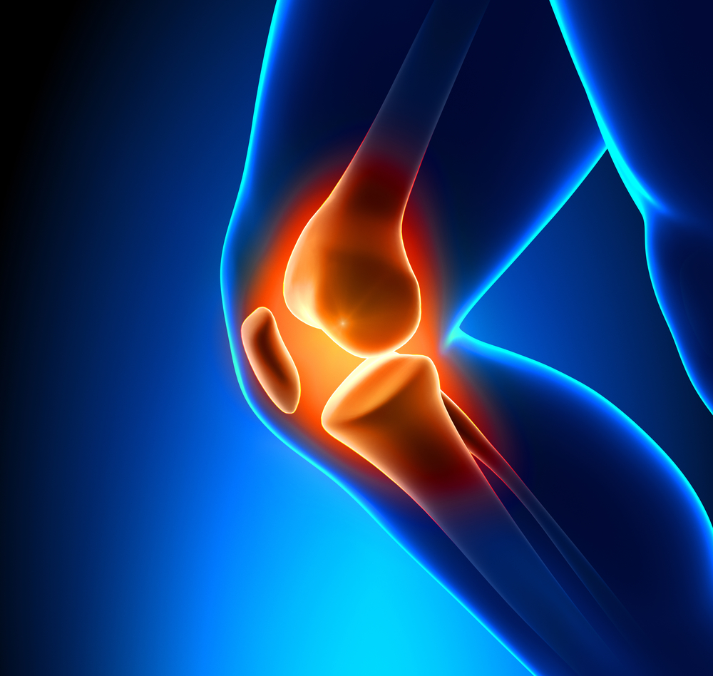 Patellofemoral Pain Syndrome