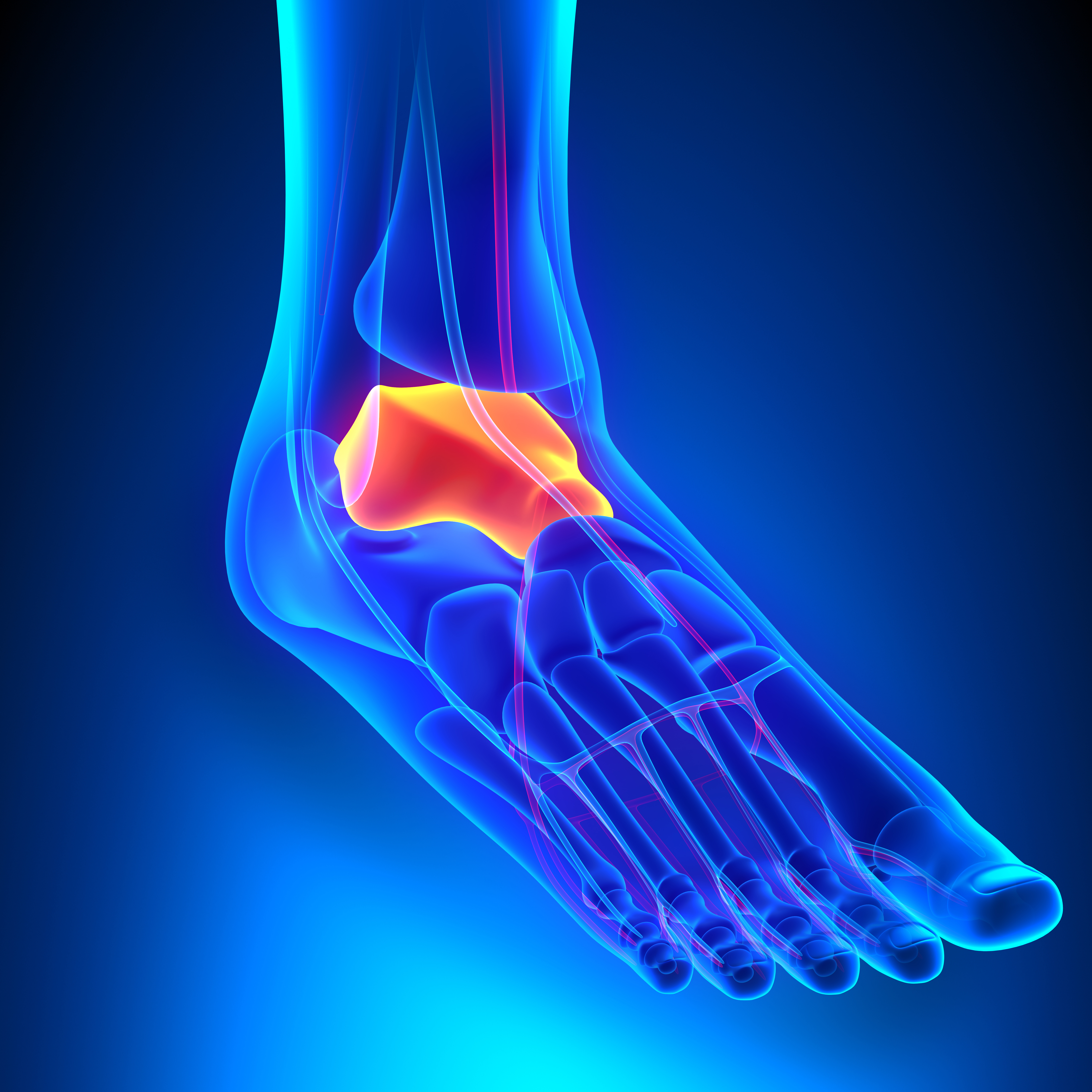 Plantar Fascia Pain